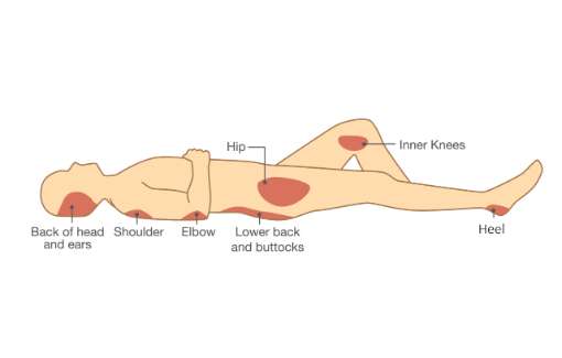 Diagram of where pressure injuries are most likely to occur when a patient is in a decubitus (lying down) position.