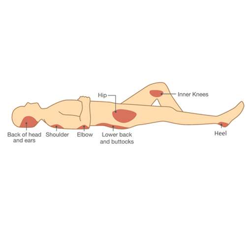 pressure sore diagram