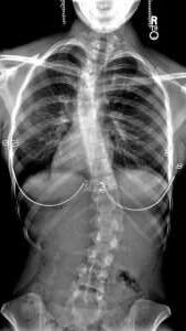 X-ray image of someone with scoliosis