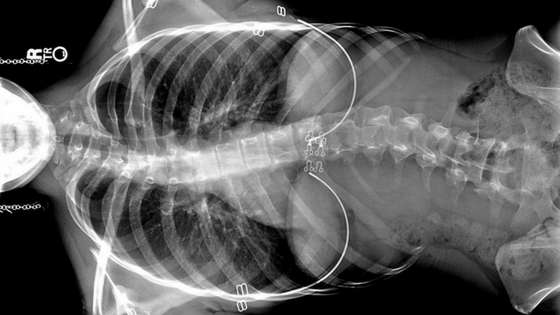 Scoliosis xray image