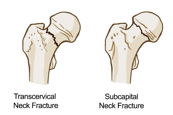 Two diagrams of the hip joint with one showing a fracture in the femoral neck, and another just below the femoral head.