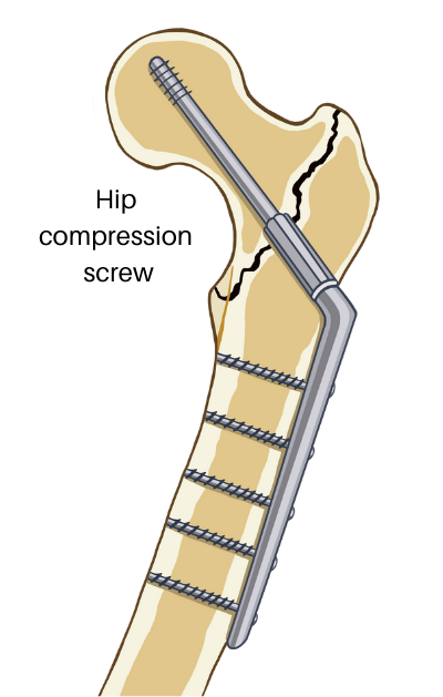 A cross-section of the hip joint with screws attaching the femur back to the femoral neck.