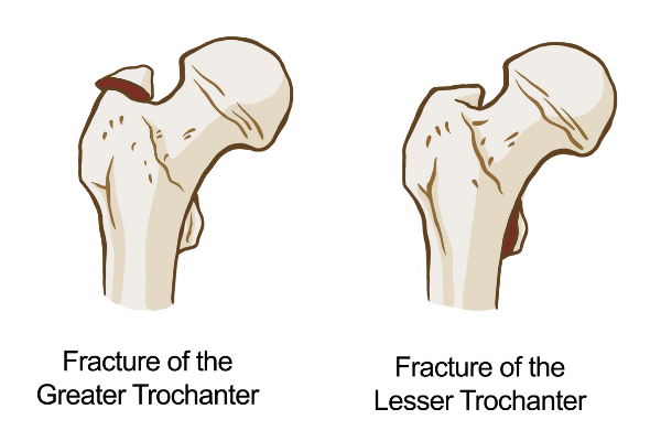 Two diagrams showing fractures in the greater trochanter and the lesser trochanter.