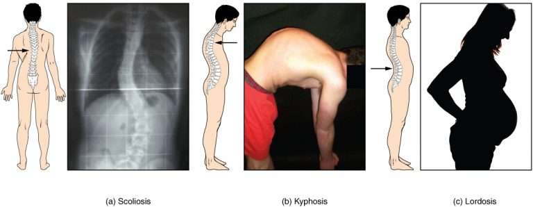 A diagram showing the differences between scoliosis, kyphosis, and lordosis