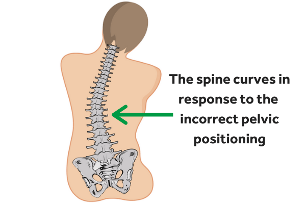 Curvature of the spine caused by pelvic obliquity