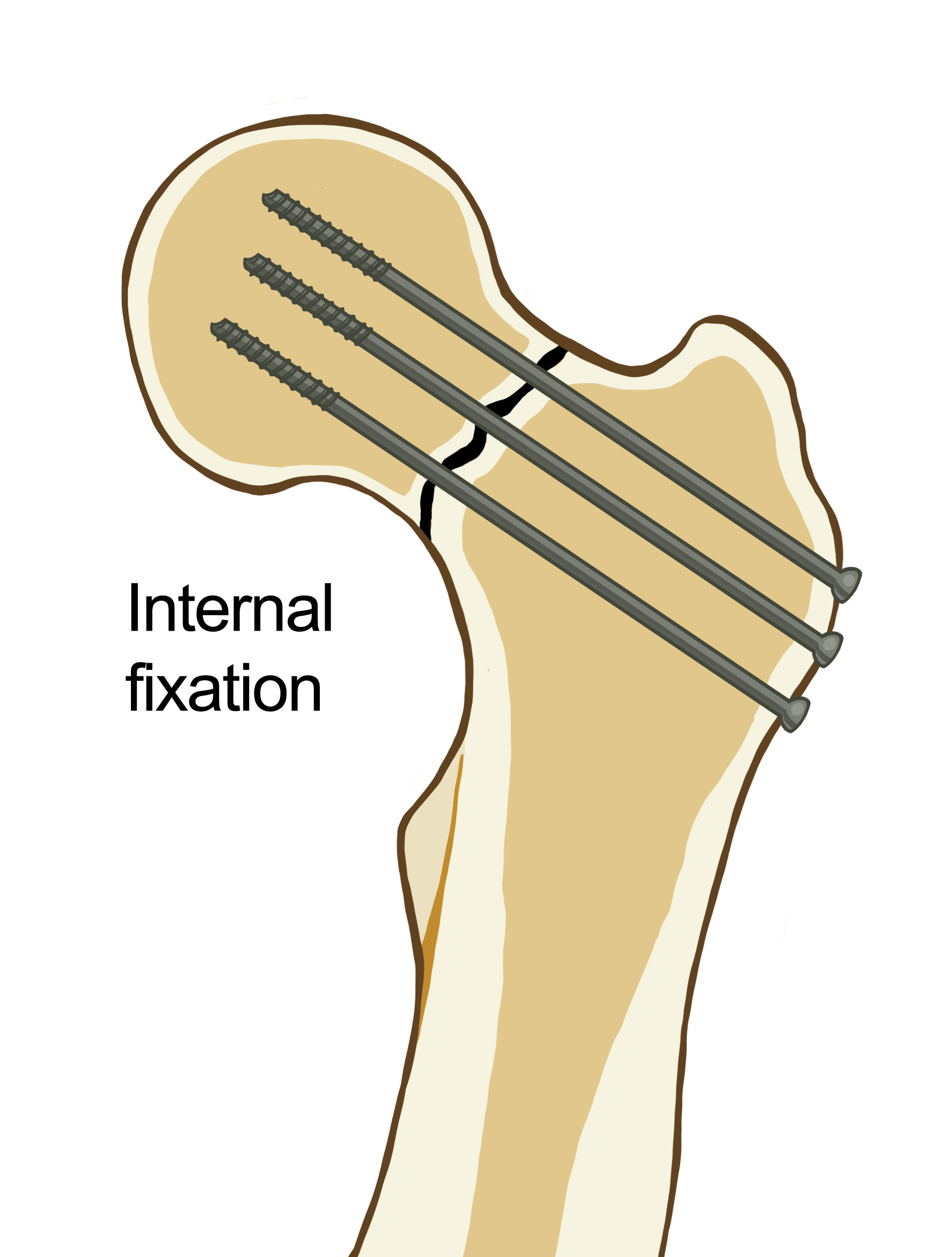 A cross-sectional diagram showing 3 screws attaching the femoral head to the femur.