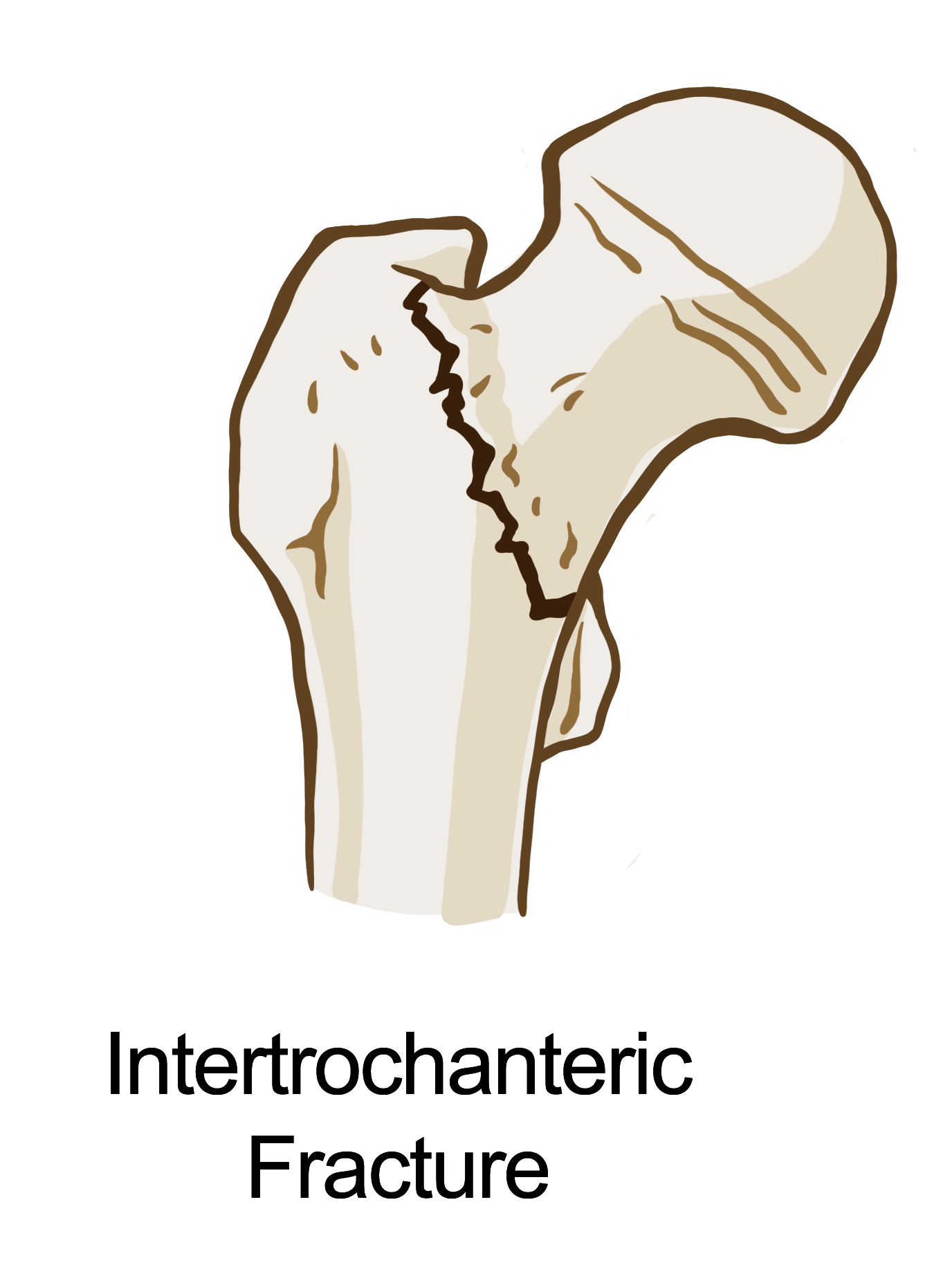 A diagram of a fracture running along the intertrochanteric area of the femur.