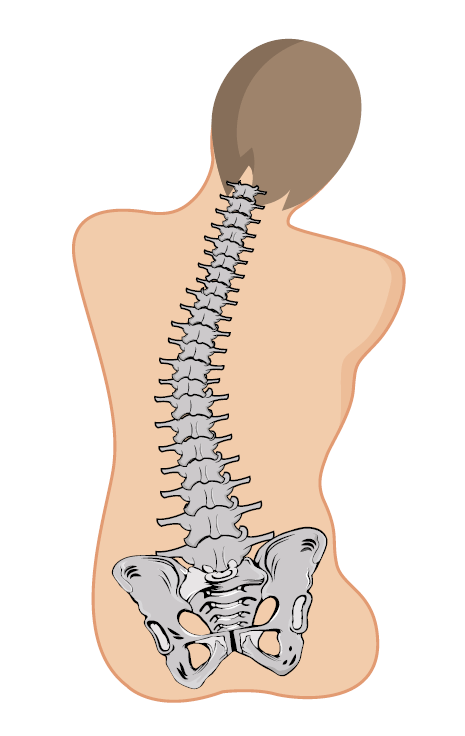 Diagram of a man with spinal curvature that causes him to lean in a chair.