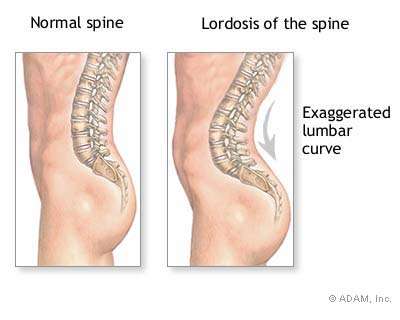 An image of a spine with lordosis