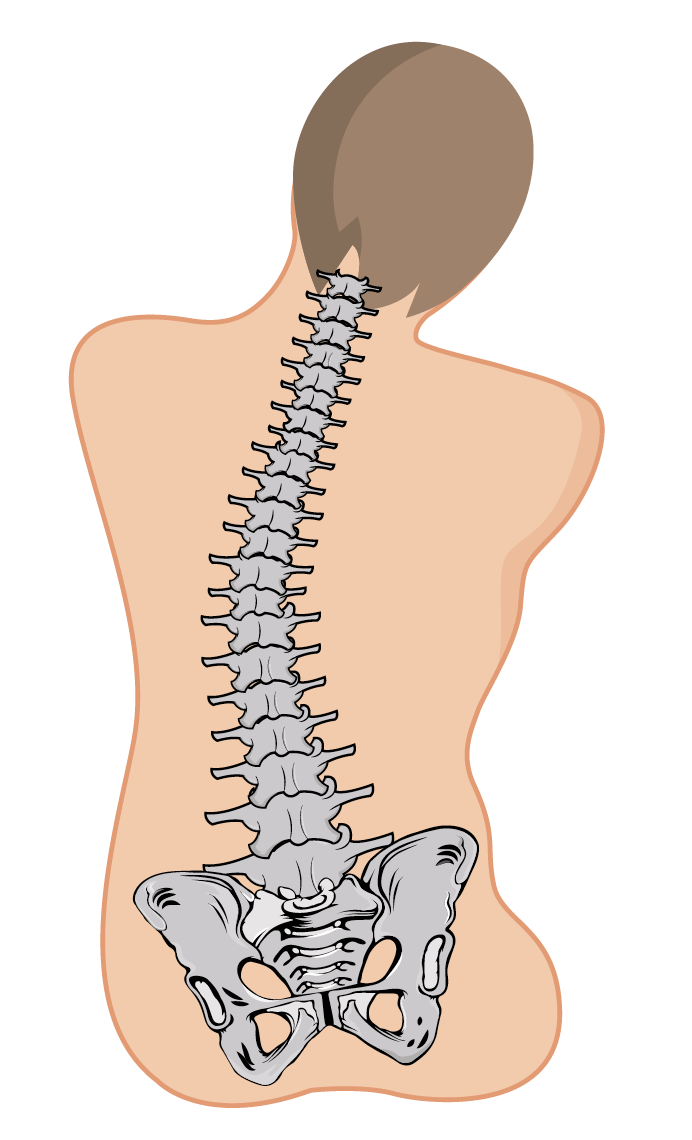 An illustration of the back of someone who is sat slouched to one side due to pelvic obliquity