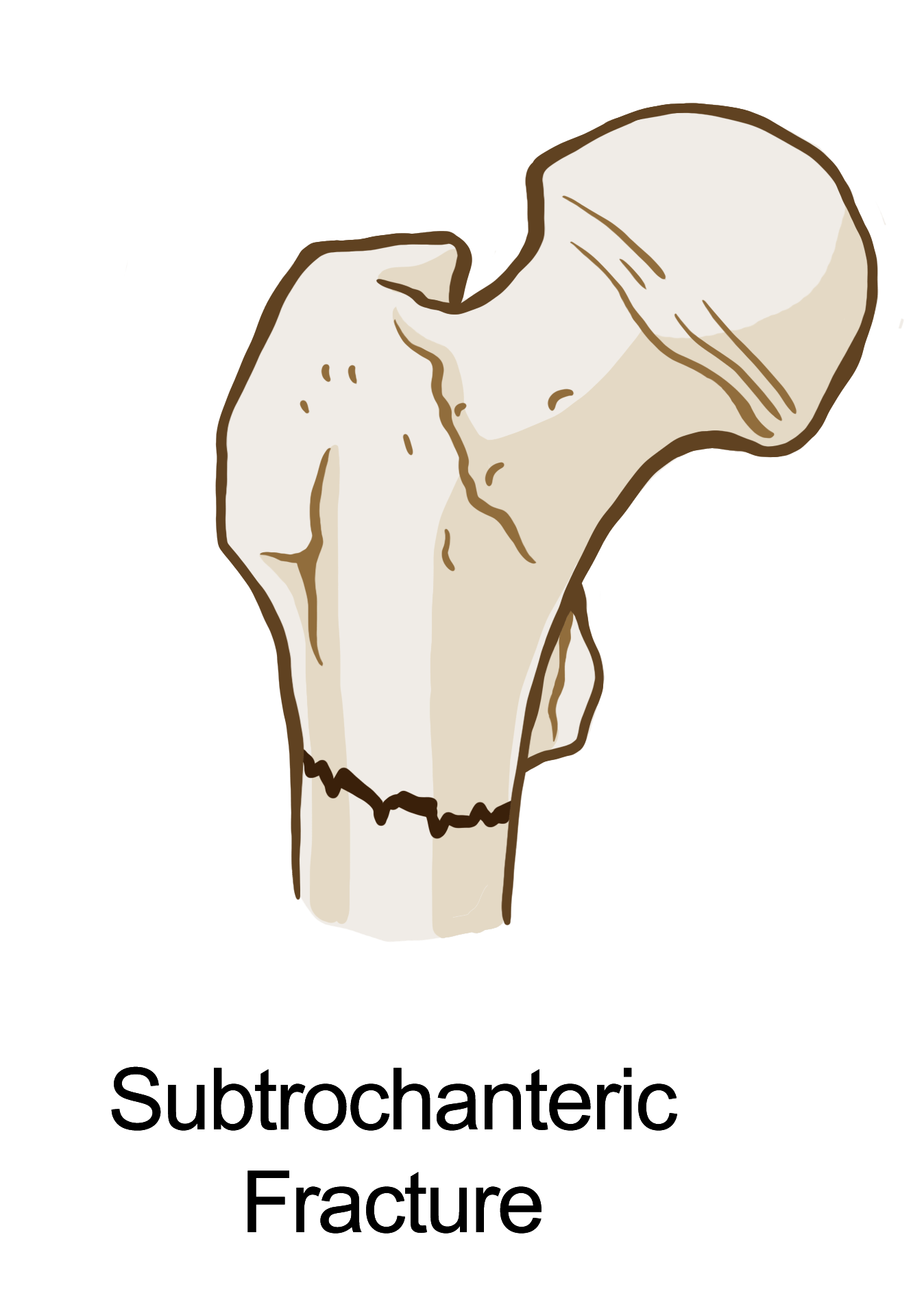 A diagram of a subtrochanteric fracture which is further down the femur.