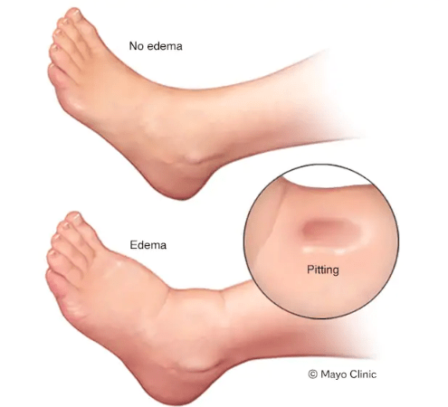 Illustration showing a comparison of a foot with edema and a normal human foot. Close up on the 'pitting' of the foot.