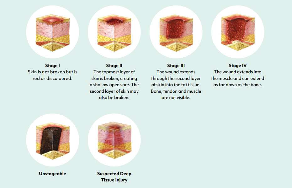 Image illustrating the various stages of pressure ulcers.