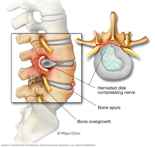 herniated disc and bone spurs