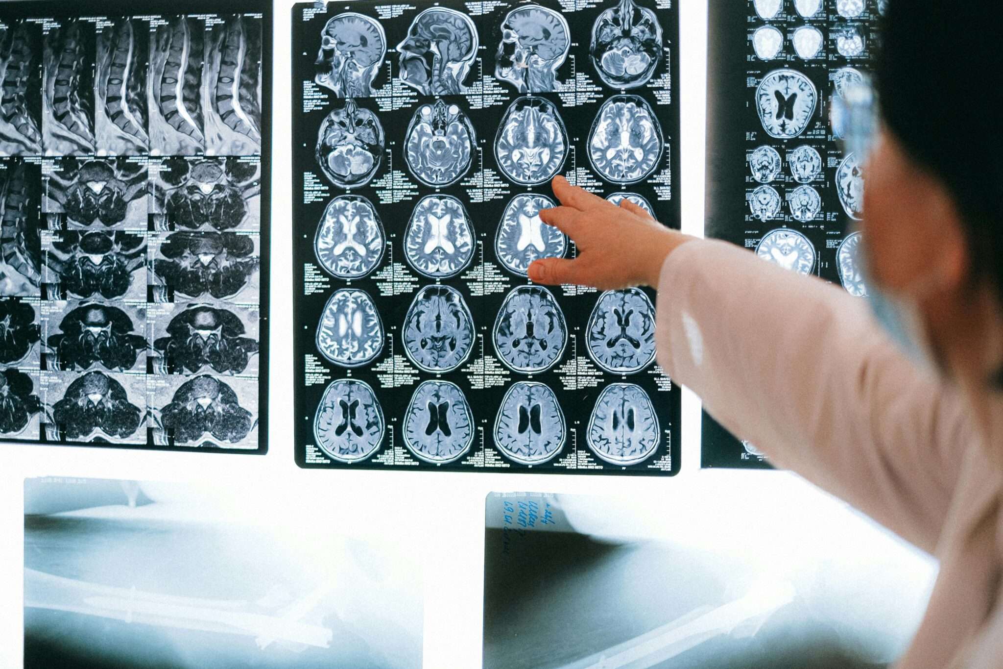 Best Seating for Chiari Malformation